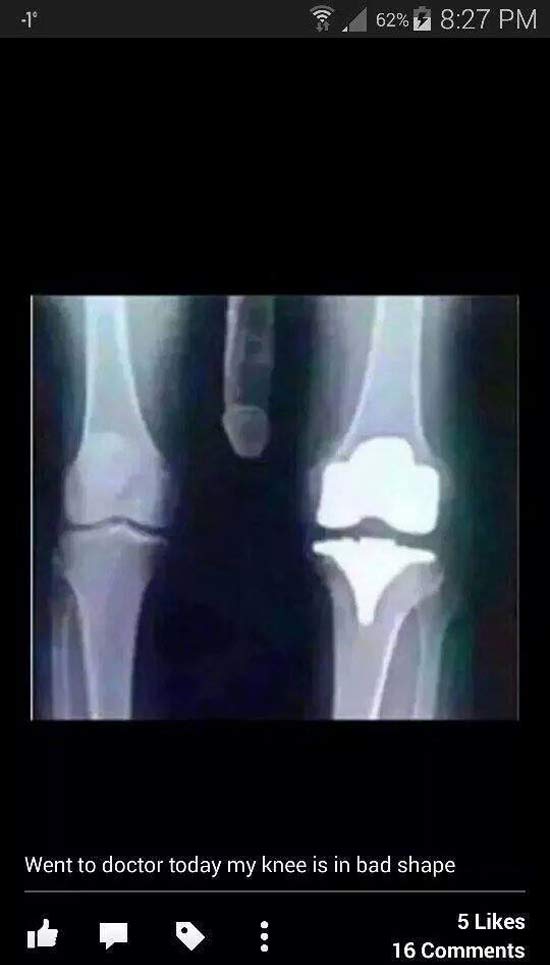 Funny Knee Xray 17 Funny Pics & Memes penis. 